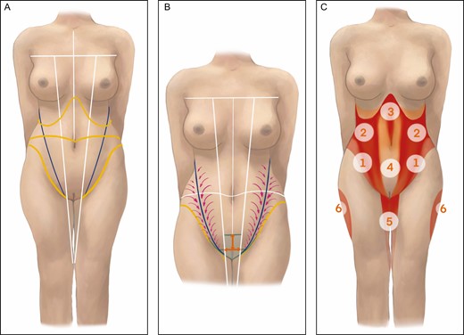 (A) Anterior illustration of trunk and thighs. The vertical midline, anterior axillary fold, and anterior body diagonal connecting the anterior midaxillary point to the pes anserinus are marked (white). The costal border as well as the inguinal crease as part of the PLAISIR line are indicated (yellow). An axillary fold-pubic tubercle line is drawn (blue). (B) A pubic unit (green) is developed by drawing a horizontal line (green) from the anterior vulvar commissure towards both inguinal creases. Halfway between the inguinal crease and the anterior vulvar commissure lies point p. The distance from point p to the midline is measured for both sides (orange). Both distances are added and copied on the midline to determine the superior base of the pubic unit. The connection between the anterior midaxillary point and point p determines the lateral side of the pubic unit. Inside this unit (green) liposuction is discouraged. Lateral to the anterior midaxillary point-p line liposuction is performed to create a pleasing depression, which is in continuation with the PLAISIR line. Further above, maximal liposuction is performed along the axillary fold-pubic tubercle line (purple arrows). (C) The designed pattern helps to determine zones of liposuction of varying intensity. Maximal aspiration zones are marked in bright red, medium aspiration zones in pink, and minimal aspiration/tunnelization zones in orange. Zones: 1, anterior lower flank; 2, anterior upper flank; 3, upper abdomen; 4, lower abdomen; 5, anterior inner thigh; 6, lateral thigh. PLAISIR, line connecting the pubic tubercle, ligamentum inguinale, anterior superior iliac spine, iliac crest, superior gluteal crease, and intergluteal region.
