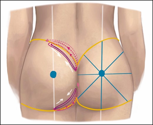 Gluteal suspension loops are placed with resorbable V-loc size 0 barbed wires. Dashed pink lines represent a superficial trajectory of the thread and solid purple lines represent the deeper trajectory. White arrows indicate the effect of the suspension loop. Yellow lines align the superior and inferior gluteal crease after the liposuction. To retrieve the buttock’s point of maximal projection, a vertical axis is drawn from the dorsal midaxillary point towards the center of the fossa poplitea, and a horizontal axis is drawn dividing the vertical axis in half between the superior gluteal crease and inferior gluteal crease. The buttock is divided in 8 parts with angles of 45° which allows to verify the buttock’s symmetry.