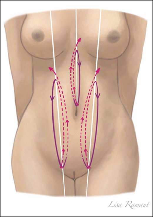 Abdominal suspension loops are introduced to achieve a better definition of the linea alba and the linea semilunaris. From an inferior incision, the thread is guided in a superficial plane (dashed pink line). The loop is completed by bringing back the thread in a deeper plane (solid purple line) before being transferred back up in a superficial plane.