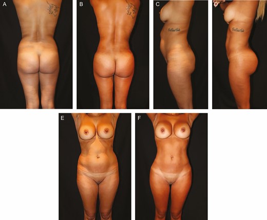 (A, C, E) Preoperative and (B, D, F) 18-month postoperative images of this 34-year-old female patient with a body mass index of 24. The total liposuction volume was 2500 mL, fat grafting volume was 300 mL per buttock, and the gluteal suspension loops were introduced. An improved waist to hip ratio is achieved as well as a shorter gluteal height. Notice how the lateral fulness of the buttock was obtained through fat grafting.
