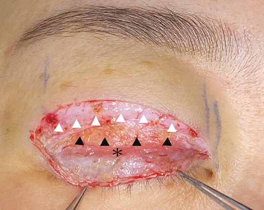 Lower flap dissection was completed, and a pretarsal tissue defect (black arrowhead) was evaluated (3 mm), indicating a severe static fold. The orbicularis oculi muscle of the upper flap (white arrowhead) was employed to prevent multiple folds. The remnant orbicularis oculi muscle of the lower flap is marked with an asterisk.