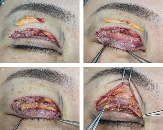 Retro-orbicularis oculus fat (ROOF) graft and orbital fat manipulation. (A) The lateral one-third of the ROOF was harvested for tissue transfer. Care was taken to reserve a thin layer of ROOF under the orbicularis oculi muscle to avoid multiple upper eyelid folds postoperatively. (B) The ROOF graft was trimmed to fit the full length of the pretarsal tissue defect. (C) The ROOF graft was sutured with the remnant orbicularis oculi muscle of the lower flap with 8-0 nylon. (D) The lower flap appeared flat after the ROOF graft. The orbital fat and posterior orbital fascia were pulled down to prevent multiple folds.
