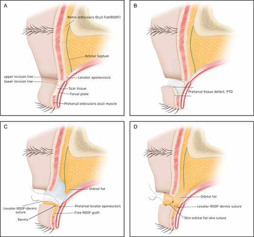 Surgical technique. (A) Preoperative design. The incision lines were drawn, and the skin between the 2 incision lines was resected. The lower flap was found to be deficient of orbicularis oculi muscle, only containing white scar tissue. Scar adhesion between the lower flap skin and tarsal plate was so tight that the lower flap was immobile during eyelid movement. (B) Lower flap dissection. The dissection was made in a caudal direction between the skin and the pretarsal fascia until the remnant orbicularis oculi muscle was seen and no tension was observed on the lower flap. The pretarsal tissue defect (PTD) was defined as the area deficient of orbicularis oculi muscle in front of the tarsal plate. It was a severe static fold with a PTD > 2 mm. (C) PTD reconstruction. Free retro-orbicularis oculus fat grafts were transferred to the lower flap with PTD, and 3 to 6 internal suture fixations were performed between the dermis and pretarsal levator aponeurosis to create a supratarsal crease. (D) Glide zone reconstruction. The orbital septum was pulled down together with orbital fat, and skin-orbital fat-skin–interrupted sutures were performed.