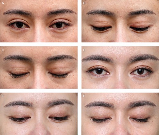 (A-C) This 37-year-old female patient before static fold revision blepharoplasty with eyes open, gazing downward, and closed. (D-F) Twelve months after revision blepharoplasty with eyes open, gazing downward, and closed.