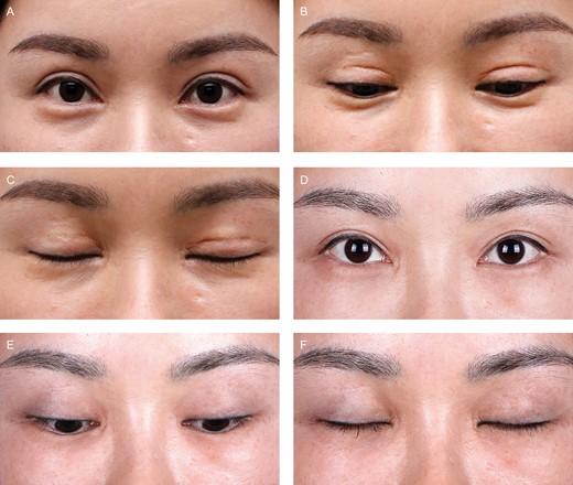 (A-C) This 35-year-old female patient before static fold revision blepharoplasty with eyes open, gazing downward, and closed. (D, E, F) Twelve months after revision, blepharoplasty with eyes open, gazing downward, and closed.