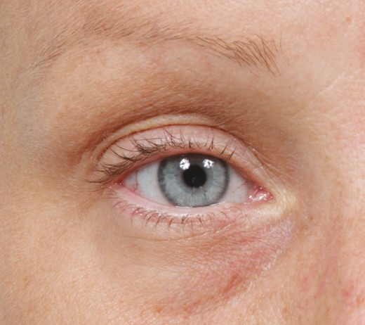 A 43-year-old Caucasian female with complete pretarsal show, defined as exposure of the eyelid crease on standardized frontal photograph.