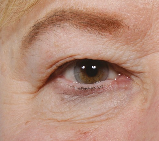 A 71-year-old Caucasian female with pseudoptosis, defined as opacification of the pretarsal space due to severe dermatochalasis.