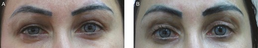 This 35-year-old female patient presented with upper eyelid edema in a centro-lateral brow edema pattern 6 months after hyaluronic acid injection to the upper eyelids with progressive swelling. (A) On presentation. (B) Three months after hyaluronidase treatment.