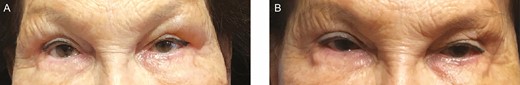 This 80-year-old female patient who underwent many hyaluronic acid treatments in the past (unknown hyaluronic acid filler was injected). (A) On presentation: centro-lateral brow edema pattern. (B) Three months after hyaluronidase treatment: 90 IU to the left upper eyelid and 90 IU to the right upper eyelid.