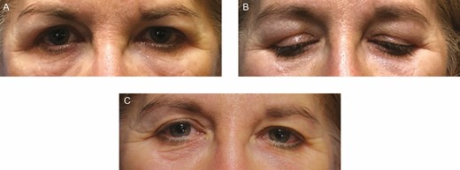 This 56-year-old female patient presenting with progressive swelling 1 year after filler injection to both upper eyelids. (A, B) On presentation. (C) Three months after injection of 90 IU of hyaluronidase to both upper eyelids.