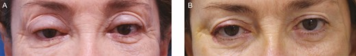 This 58-year-old female patient who underwent hyaluronic acid filler injection 1 year before the development of upper eyelid edema in a supero-medial pattern. (A) On presentation. (B) Three months after injection of 10 IU of hyaluronidase on each side.