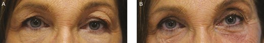 This 64-year-old female patient with history of previous hyaluronic acid injections in the past (unknown filler material). (A) On presentation – a centro-lateral brow edema pattern. (B) 3 months after 30 IU of hyaluronidase to each of 3 points in the left upper eyelid.