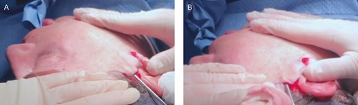 Intraoperative photographs of a 55-year-old female undergoing ABC facelift with lipoharvest from the abdomen and bilateral outer thighs. (A) Power-assisted, hydrodissection following adipose grafting. (B) Baraf elevator for takedown of perpendicular subcutaneous fibers.