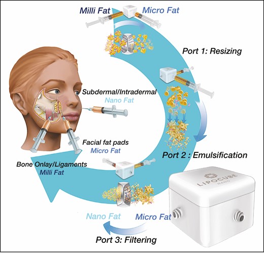 ITR2 for anatomic fat grafting in the ABC facelift uses mechanical dissociation of millifat harvested with a 1.8-mm × 1-mm hole cannula and processed with a small “lab-in-a-box” (Nanocube; Lipocube, Inc., London, UK) into microfat (1-mm parcel size) and cell-optimized nanofat (500-μm parcel size). Fat processed with the Nanocube retains the fibrous tissue matrix with regenerative stromal vascular fraction cells. ITR2, injectable tissue replacement and regeneration.