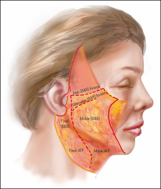 Schematic representation of SMAS cautery dissection. SMAS, superficial muscular aponeurotic system; APE, auricular platysmal fascia.