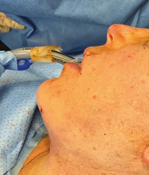 Intraoperative photograph of a 70-year-old female following suturing of the SMAS flap and skin during an ABC facelift. Note the appearance of the skin flaps, which demonstrate little bruising or venous engorgement at the conclusion of the case.