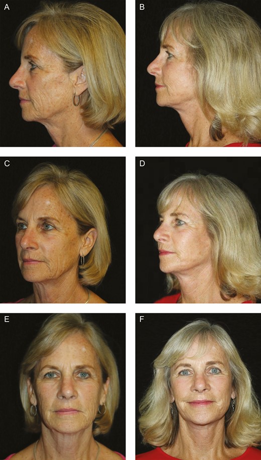 (A, C, E, G, I) Preoperative and (B, D, F, H, J) 1-year postoperative photographs of a 62-year-old woman who underwent an ABC facelift.