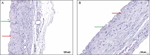 (A) HE staining of the capsules of nanotextured implants. The green arrows show the peaks, and the red arrows show the valleys (×10 magnification). (B) HE staining of the capsules of nanotextured implants. The green arrows show the peaks, and the red arrows show the valleys (×20 magnification). HE, hematoxylin-eosin.