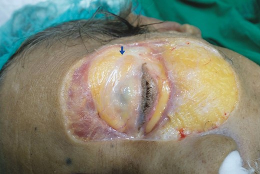 An illustration of a 60-year-old female fresh cadaver with preorbital septum fiber on her left upper eyelid. The preorbital septum fiber is marked with a blue arrow.
