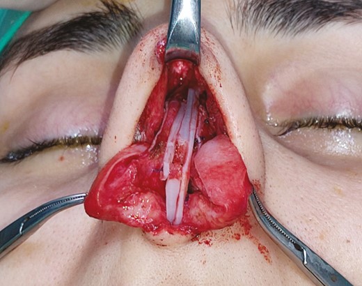 Application of right mucoperichondrial spreader flap in this 22-year-old female patient with a left-sided deviated nose.