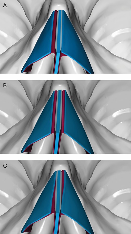 (A) Unilateral, (B) bilateral symmetrical, and (C) bilateral asymmetrical application of the mucoperichondrial spreader flap.