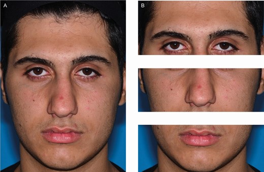 Subjective assessment of facial asymmetry. (A) Preoperative image of this 21-year-old male patient. (B) The image was divided into 3 units. Authors’ opinions about asymmetry of each unit were noted subsequently.