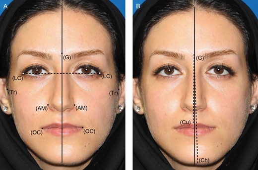 Objective assessment of facial asymmetry. Soft tissue landmarks for anthropometric measurements of this 36-year-old female: glabella (G), lateral canthus (LC), alar margin (AM), tragus (Tr), oral commissure (OC), cupid’s bow (Cu), and the most prominent point of chin (Ch). (A) Measuring distance between landmarks and reference line. (B) Measuring axial deviation of face.
