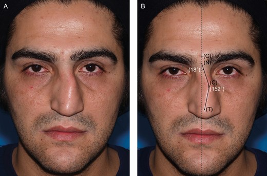 Nose deviation angle measurement for C-type noses: glabella (G), nasion (N), prominent point of convexity (C), and tip of nose (T). (A) Preoperative image of this 37-year-old male. (B) Measuring the angle between the NC line and reference line, and the angle between NC line and CT line.