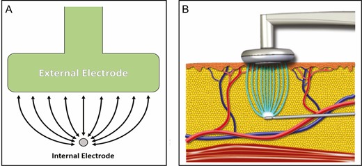 (A) Schematic depicting the flow of radiofrequency energy between the internal and external electrodes. (B) Idealized image of radiofrequency energy transfer within tissue.