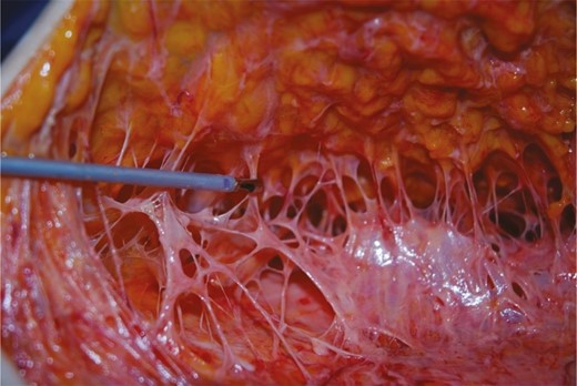 Deep fibrous tissue target for radiofrequency energy. (Reprinted with permission of Oxford University Press.16)