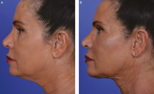 A 53-year-old female patient whose neck was treated with FaceTite. (A) Pretreatment. (B) Posttreatment—1 month.