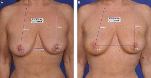 A 61-year-old female who received FaceTite treatment to circumferential breast with calibrated measurements. (A) Pretreatment. (B) Posttreatment—3 months.