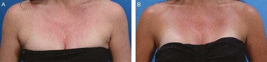 A 48-year-old female with axillary “bra fat” treated with liposuction and FaceTite. (A) Pretreatment. (B) Posttreatment—3 months.