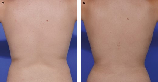 A 61-year-old female whose back and flank were treated with VASER and BodyTite. (A) Pretreatment. (B) Posttreatment—3 months.