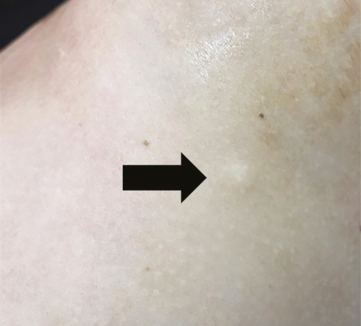 Dermal end hit—immediate intraoperative appearance (arrow) in a 42-year-old female.