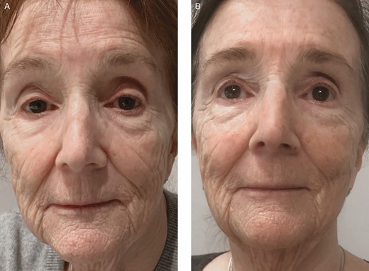 Clinical example of skin rejuvenation (rhytids and dyschromia) with LLLT. A 73-year-old female treated with a homeuse dual-wavelength LLLT device at 470 and 808 nm for 20 minutes/day for 12 weeks. (A) Pretreatment and (B) 1 week after discontinuation of treatment. LLLT, low-level light therapy.