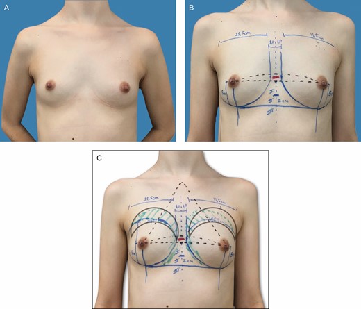 (A-C) Preoperative markings on a 31-year-old patient with bilateral symmetric hypomastia and pinch test of 1.0 cm. These skin marks include current symmetric inframammary fold, lateral limit of the pocket, represented by the anterior axillary line, midsternal line, and parasternal lines, with an average distance of 2 to 3 cm between the breasts and the area of fat grafting in the upper pole.