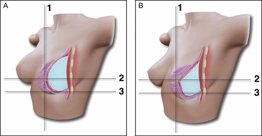 (A,B) Schematic representation of the conventional breast augmentation technique outcome and the relation of the lower pole stretching and upper pole projection. Breast augmentation by the axillary approach, subfascial pocket, and ergonomic implant with no fat grafting. Due to the viscoelastic properties of the gel, greater projection tends to occur in the lower pole, with consequent loss of projection in the upper pole. Lines 1 and 2 mark the position of the nipple-areola complex; line 3 is the position of the inframammary fold.