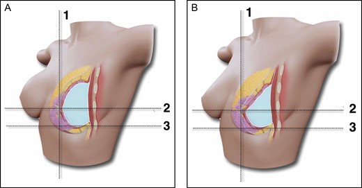 (A,B) Schematic representation of the subfascial ergonomic axillary hybrid technique outcome and the relation of the lower pole stretching and upper pole projection. Breast augmentation through the axillary approach, subfascial pocket, ergonomic implant and fat grafting. The fat graft in the upper pole provides better balance between the upper and lower poles and consequently maintains projection after the implant reaches its final position. Lines 1 and 2 mark the position of the nipple-areola complex; line 3 is the position of the inframammary fold.