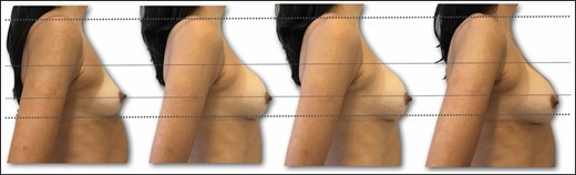 Preoperative right lateral view of a 36-year-old female patient with bilateral symmetric hypomastia. Outcome for implant position and lower pole stretching during follow-up period (preoperative, 10 days, 3 months, 18 months).
