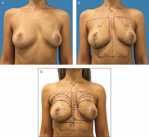(A-C) Preoperative markings on a 37-year-old patient with bilateral asymmetric hypomastia and pinch test of 1.0 cm. These skin marks include current inframammary fold, 2.0-cm difference between the right and left current inframammary fold, lateral limit of the pocket, represented by the anterior axillary line, midsternal line, and parasternal lines, with an average distance of 2 to 3 cm between the breasts and the area of fat grafting in the upper pole and parasternal region.