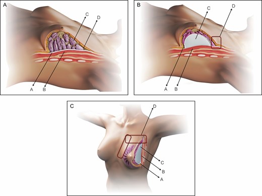 Schematic representation of the SEAH procedure. (A) Normal anatomy of the left breast, preoperative view: pectoralis fascia (A), pectoralis major muscle (B), glandular tissue (C) and upper pole subcutaneous tissue (D). (B) Normal anatomy of the left breast, intraoperative view following subfascial breast augmentation by the axillary approach: pectoralis fascia (A), pectoralis major muscle (B), silicone gel implant (C), and upper pole transition with abrupt limit (D). (C) Normal anatomy of the left breast, intraoperative left oblique view following subfascial breast augmentation by the axillary approach: pectoralis fascia (A), pectoralis major muscle (B), silicone gel implant (C), and upper, upper-medial, and medial pole transition with abrupt limit (D).