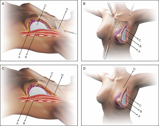 Schematic representation of the SEAH procedure. (A) Normal anatomy of the left breast, intraoperative view following subfascial breast augmentation with the axillary approach and during fat graft into the upper pole transition: pectoralis fascia (A), pectoralis major muscle (B), silicone gel implant (C), and fat grafting into the upper pole performed with a 3 mL syringe and a 1.9-mm cannula (D). (B) Normal anatomy of the left breast, intraoperative left oblique view following subfascial breast augmentation with the axillary approach and during fat graft into the upper, upper-medial, and medial pole transition: pectoralis fascia (A), pectoralis major muscle (B), and silicone gel implant (C). (C) Normal anatomy of the left breast, postoperative view following SEAH procedure: pectoralis fascia (A), pectoralis major muscle (B), fat graft over the area of the silicone gel implant (C), and fat graft over the area of the transition between the area with the silicone gel implant and the upper pole (D). (D) Normal anatomy of the left breast, postoperative left oblique view following SEAH procedure: pectoralis fascia (A), pectoralis major muscle (B), silicone gel implant (C), and fat graft over the area of the transition between the area with the silicone gel implant and the upper pole (D).