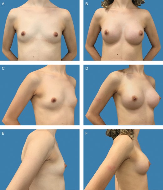 Preoperative frontal (A), left oblique (C), and lateral (E) views of a 31-year-old female patient with bilateral symmetric hypomastia. Preoperative markings and surgical planning are shown in detail in Figure 1A-C. Presence of symmetric inframammary folds, with pinch test of 1 cm. (B, D, F) Appearance 2 years postprocedure, showing very good outcome with bilateral 255-cc Motiva SmoothSilk surface Ergonomix implants, combined with 85 and 95 mL of autologous fat graft on the upper and upper-medial poles on the left and right sides, respectively.