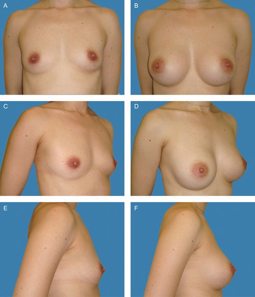 Preoperative frontal (A), left oblique (C), and lateral views (E) of a 26-year-old female patient with bilateral symmetric hypomastia. Presence of symmetric inframammary folds, with pinch test of 1.5 cm. (B, D, F) Appearance 2 years postprocedure, showing very good outcome with bilateral 275-cc Motiva SmoothSilk surface Ergonomix implants, combined with with 75 and 25 mL of autologous fat graft on the upper and upper-medial poles on the left and right sides, respectively.