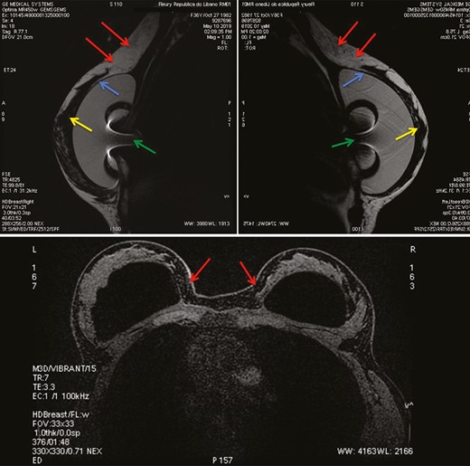Sagittal plane of subtracted T1-weighted images from left (upper-left) and right (upper right) breast MRI in a 37-year-old woman 1 year after a subfascial ergonomic axillary hybrid procedure due to severe hypomastia and breast asymmetry showing the position of the silicone implants in the subfascial pocket. Axial plane (below) of subtracted T2-weighted images from breast MRI of the same patient. In the sagittal images (above, left and right) it is possible to observe the fat graft integrated in the upper region of the breast, promoting a homogeneous transition between the region with and without the silicone implant (red arrows). The blue and yellow arrows show the pectoral fascia and the breast parenchyma, respectively. The green arrow represents the radiofrequency identification system artifact inside the silicone gel. The axial image (below) shows the proper position of the implant and the fat graft integrated in the parasternal region. No cases of suspicious calcifications, fat necrosis, or lumps were observed.