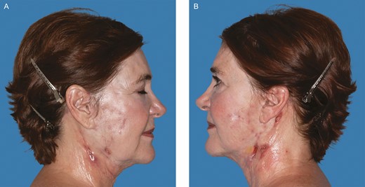 The 67-year-old female patient with neck lesions 4 months following a facelift procedure. Photograph taken at the time of referral. (A) Right. (B) Left. (June 21, 2019.)