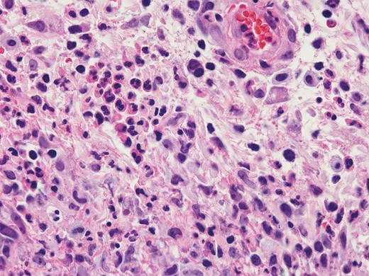 Skin biopsy demonstrating mixed dermal inflammation with numerous neutrophils and histiocytes (hematoxylin-eosin, 600× original magnification). (July 5, 2019.)
