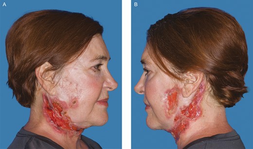 Further progression of the disease process after the patient was weaned from systemic steroid therapy 6 months after her initial procedure. (A) Right. (B) Left. (August 1, 2019.)