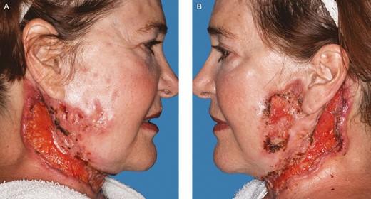 Further progression of the disease process, 3 weeks after follow-up in Figure 3. (A) Right. (B) Left. (August 22, 2019.)